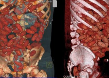 Cocaina: gahanese di 28 anni muore per gli ovuli ingeriti