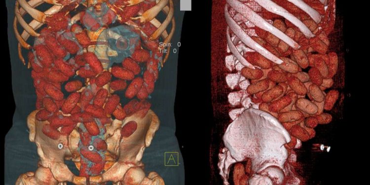 Cocaina: gahanese di 28 anni muore per gli ovuli ingeriti